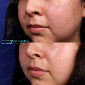 SR SHI 66 Hypertrophic Scarring Patient Results Scar Healing