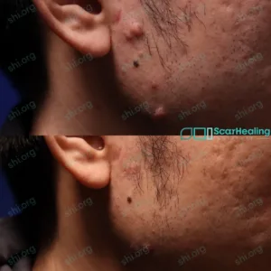 ZH SHI 50 - Keloid Scar Patient Results Scar Healing