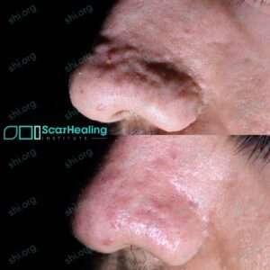 SB2 SHI 107 - Acne Scarring Patient Results Scar Healing