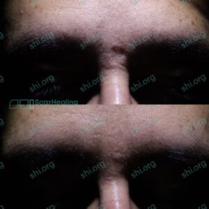JG SHI 109 - Atrophic Scarring Patient Results Scar Healing