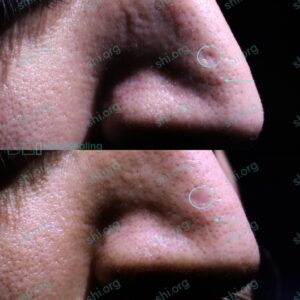 KB SHI 108 - Acne Scarring Patient Results Scar Healing