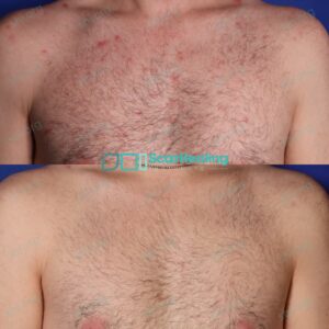 LA SHI 110 Active Acne Patient Results