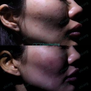 LL SHI 111 - Acne Scarring Results Scar Healing