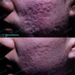 ER SHI 114 - Acne Scarring Results Scar Healing