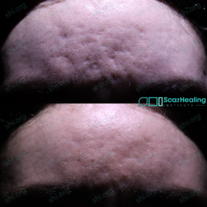 LM2 SHI 113 - Acne Scarring Results Scar Healing