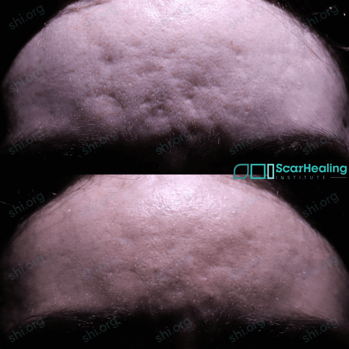 LM2 SHI 113 LM2 SHI 113 - Acne Scarring Results Scar Healing