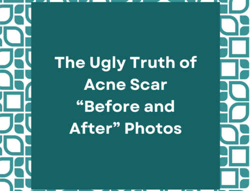 The Ugly Truth of Acne Scar “Before and After” Photos