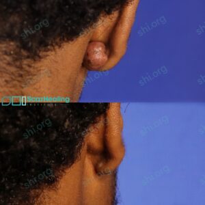 RW SHI 112 - Keloid Scar Patient Results Scar Healing