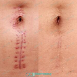 JA SHI 52 Hypertrophic Surgical Scarring Patient Results Scar Healing