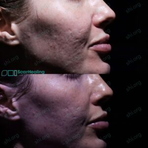 CJ SHI 116 - Acne Scarring Results Scar Healing