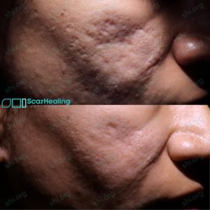 KA SHI 118 - Acne Scarring Results Scar Healing