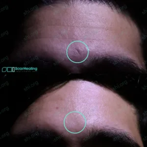 NK SHI 17 - Traumatic Scarring Patient Results Scar Healing