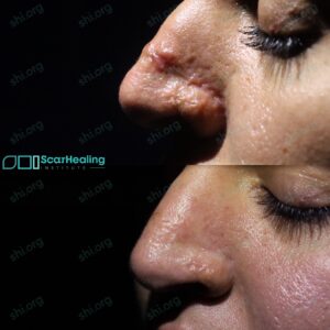 JG2 SHI 119 - Hypertrophic Scarring Patient Results Scar Healing