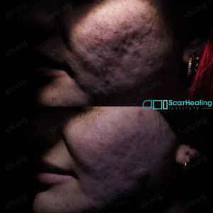 MS2 SHI 120 - Acne Scarring Results Scar Healing