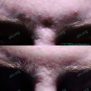 NK SHI 92 - Atrophic Scarring Patient Results Scar Healing