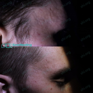 AD SHI 121 - Acne Scarring Active Acne Patient Results Scar Healing