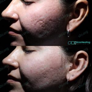 BB SHI 122 - Acne Scarring Active Acne Patient Results Scar Healing
