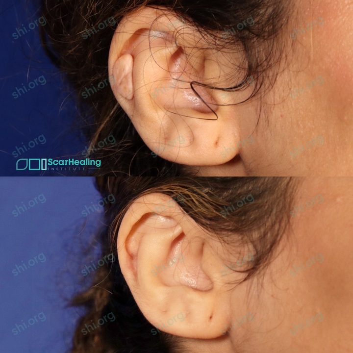 DP_SHI_123 DP Scar Healing Institute 123 - Keloid Scar Patient Results Scar Healing