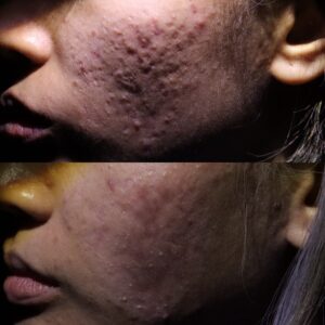 KL SHI 124 - Acne Scarring Active Acne Patient Results Scar Healing